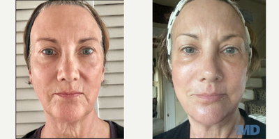 55-64 year old woman treated with NeoGen Plasma - This lovely patient received 1 high energy NeoGen treatment. Notice the dramatic improvement to her skin texture, tone and tightness! The patient is especially thrilled with the minimized wrinkles/fine lines around her mouth and the tightening on her neck.