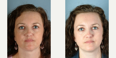 35-44 year old woman treated with Obagi Nu-Derm - 35-44 year old woman treated with Obagi Nu-Derm