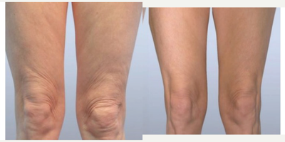 45-54 year old woman treated with Knee Skin Tightening with Bodytite - 45-54 year old woman treated with Knee&nbsp;Skin Tightening with Bodytite