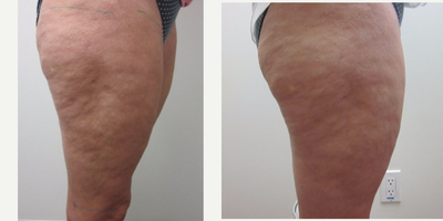 55-64 year old woman treated with Cellulite Treatment - BodyFX uses a combination of radiofrequency energy to distribute heat to the skin and underlying fat causing contraction of the skin, deep tissue heating for collagen stimulation, and suction coupled negative pressure to provide beautiful body contouring.