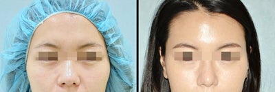 Rhinoplasty - 
	Rhinoplasty&nbsp;
