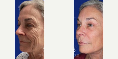 55-64 year old woman treated with Brow Lift, Eyelid Surgery - 55-64 year old treated with Brow Lift, Eyelid Surgery