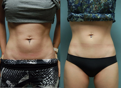 31 year old woman treated with SculpSure. 10 weeks post op - This slim woman, in great shape had a little bit of extra fat below her navel that she wanted to remove. She had one treatment with SculpSure and is seen 10 weeks after that treatment.
