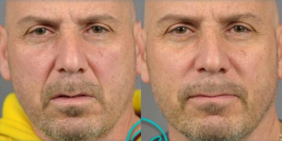 Man treated with Voluma, Juvederm - Voluma to cheeks, Juvederm to folds