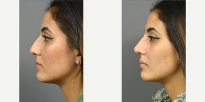 Woman treated with Nonsurgical Nose Job, Dermal Fillers - Liquid Rhinoplasty, or Non-Surgical Rhinoplasty, is the use of injectable dermal fillers to alter the shape of the nose. While its not the right procedure option for everyone, it is a great way to correct minor, isolated deformities or asymmetries and/or add definition to the nose.