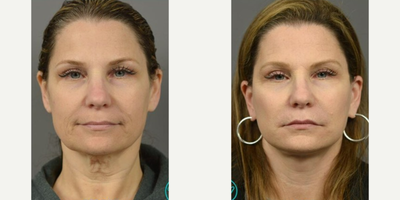 Woman treated with Mini Facelift - This transformation was achieved with Dr. Marottas signature EZ Lift Plus. This variety of mini-facelift allows for an excellent degree of correction with less downtime and shorter incisions than a traditional facelift.
