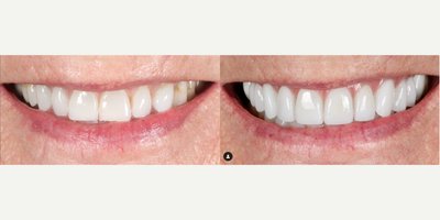 Woman treated with Smile Makeover, Porcelain Veneers, Dental Crown - A permanently white smile, who wouldnt want it?! This patient was tired of whitening her teeth and never seeing any results. Years of wear on her teeth caused recession and fracture lines that allowed stain to remain that no amount of whitening could undo.Now, she has no need to whiten anymore!!!