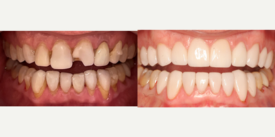35-44 year old man treated with Dental Crown - Dental Crown rehabilitation