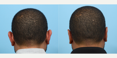 35-44 year old man treated with Earfold - This 36-year-old patient had an otoplasty, commonly referred to as ear pinning surgery, in order to reduce the size and projection of his ears. 10 weeks post-op the patient is happy to see such a huge improvement in his overall appearance and feels much more confident wearing his hair short.