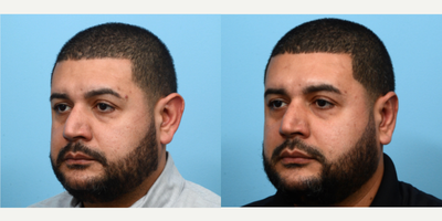 35-44 year old man treated with Earfold - This 36-year-old patient had an otoplasty, commonly referred to as ear pinning surgery, in order to reduce the size and projection of his ears. 10 weeks post-op the patient is happy to see such a huge improvement in his overall appearance and feels much more confident wearing his hair short.