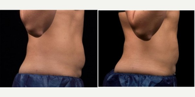 35-44 year old man treated with Liposonix - 35-44 year old man treated with Liposonix