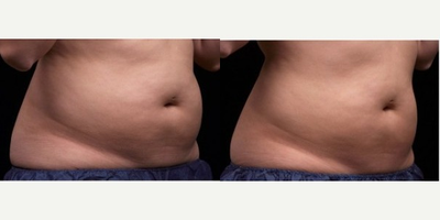 35-44 year old man treated with Liposonix - 35-44 year old man treated with Liposonix