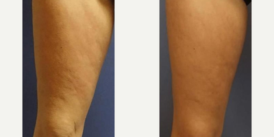 Woman treated with BodyFX - Woman treated with BodyFX