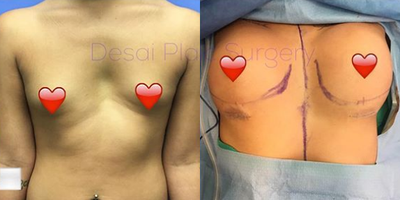 Woman treated with Breast Augmentation - Woman treated with Breast Augmentation with 685cc/600cc MP Profile Gummy Bear Implants