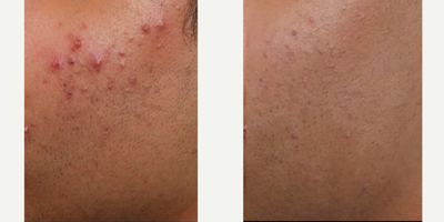 Patient treated with AviClear - Treat mild, moderate, and severe acne in just three, 30-minute AviClear sessions.This patient completed three sessions and the after pic is three months after his final session.
