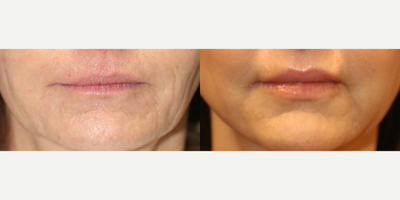 45-54 year old woman treated with Lip Surgery - This is a 52 year old female patient who is 510, 148 pounds.  She was not happy with how thin her lips look.  She underwent fat transfer to her lips with Dr. J. Timothy Katzen.  She is happy with how full her lips are now.