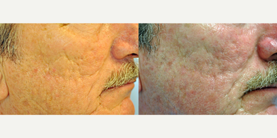 Man treated with Subcision - Man treated with Subcision.