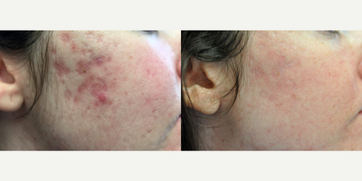 Woman treated with Pixel Laser - Woman treated with Pixel Laser.