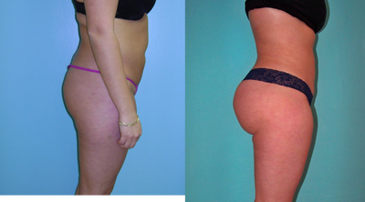 Brazilian Butt Lift- Buttocks Augmentation - Before and After Brazilian Butt Lift- Buttocks Augmentation