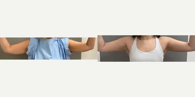 18-24 year old woman treated with Liposuction of the arms - 24 yo s/p liposuction of the arms performed under local anesthesia with sedation in our on site AAAA certified operating suite