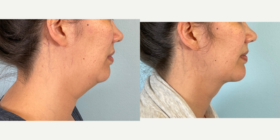 35-44 year old woman treated with Jawline Sculpting, Morpheus8, Radiesse - 35-44 year old woman treated with Jawline Sculpting, Morpheus8, Radiesse