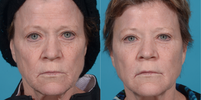 55-64 year old woman treated with Liquid Facelift:  Bellafill, Juvederm, and Botox - Facial rejuvenation with 1 kit Bellafill (6 syringes) to temples, lower eyelids/cheek, nasolabial folds, marionette lines.  1 syringe Juvederm to upper and lower lip lines.  50 units Botox to Forehead, Glabella, and Crow's Feet.