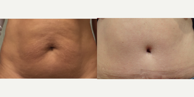 45-54 year old woman treated with Belly Button Surgery - Patient had breast reconstruction using her abdominal tissue (DIEP flap).  Care was taken to create a nice umbilicus.