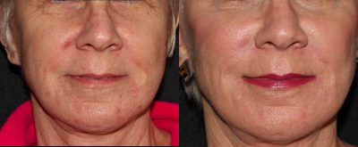 62 Year Old Female Treated for Volume Loss to Upper Cheeks and Lower Face - 2 Syringes of Voluma; 1 syringe of Juvederm Ultra Plus XC; Botox to glabella, forehead, crows feet, and chin