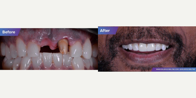 45-54 year old man treated with Dental Implants, Porcelain Veneers, Dental Crown - 1 Implant, 1 crown over teeth and Porcelain Veneers.