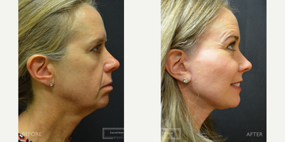 51 year old woman treated with Facial Fat Transfer, Brow Lift - This 51 year-old female was unhappy with the appearance of her face and brow. Being very athletic, the additional loss of natural fat was very troubling to her. Restoration of this fat volume was performed with precise fat transfer to the cheeks, jowls and facial folds. In addition, a deep plane facelift, neck lift and endoscopic browlift was utilized to resuspend the facial tissues to a more youthful position. Her results at 8 months show barely perceptible scars and beautiful contour.