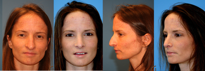 Rhinoplasty also known as nose job - 
	This rhinoplasty patient always wanted a smaller and natural nose that fits her face. She had an open rhinoplasty.&nbsp;
