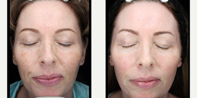 45-54 year old woman treated with Clear and Brilliant - Full face clear and brilliant