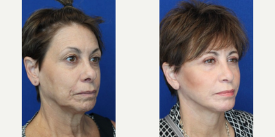 Woman treated with Laser Resurfacing - Woman treated with Laser Resurfacing