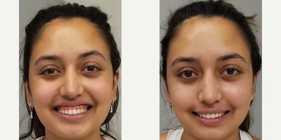 Woman treated with Botox for Gummy Smile - Woman treated with Botox for Gummy Smile