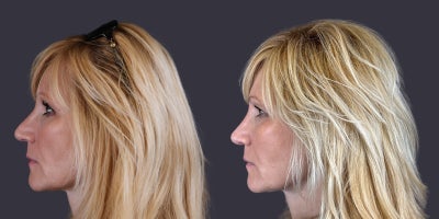 55-64 year old woman treated with Rhinoplasty, Revision Rhinoplasty, Septoplasty - This 57 year old woman is 5'11 and 185 pounds. She had a rhinoplasty about 30 years ago. She wanted to reduce and straighten her nasal bridge. She had an open rhinoplasty using septal cartilage grafts to help improve the shape to be more what she wanted.