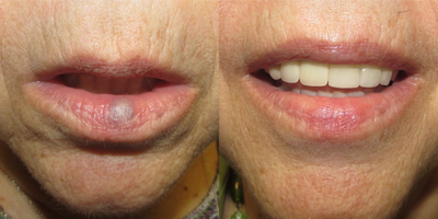 65-74 year old woman treated with 1064 Long Pulsed Dye Laser  - 65-74 year old woman Venous Lake on her lip treated with 1064 Long Pulsed Dye Laser.