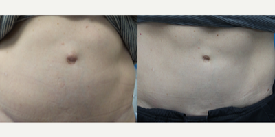 52 year old woman treated with Umbilical Hernia Repair - This patient was concerned with the appearance of her belly button after an umbilical hernia. Dr. Hamori performed an Umbilical Hernia Repair to give a more natural appearance.