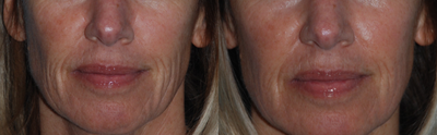 45-54 year old woman treated with Morpheus8 - Before and one week after one Morpheus8 treatment. The lines around her mouth are softer and patient will continue to see results after a series of 3 treatments.