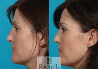 29 year old woman treated with Rhinoplasty - The patient is a 29-year-old woman with a history of nasal trauma. In addition to problems with nasal breathing, she noticed a change in the shape of her nose following her injury. She underwent correction of both functional and cosmetic issues with her nose. This was performed as an outpatient surgical procedure and she was able to return to work within one week. The photographs were taken approximately 2 months after her surgery.
