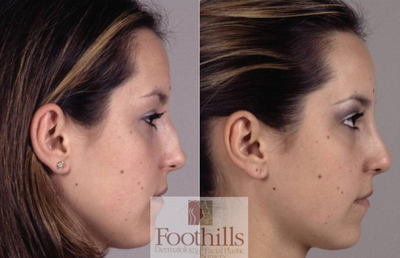 18-24 year old woman treated with Rhinoplasty - The patient is a 19-year-old woman who was interested in reducing the appearance of the hump of her nose. She also underwent correction of a deviated nasal septum at the same time. This procedure was performed on an outpatient basis. She was back at school within five days and these photographs were taken approximately 3 months later. She was pleased with the appearance of her nose and reported the function was greatly improved.