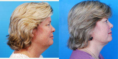45-54 year old woman treated with Laser Liposuction - This a woman who desired a chin/neck reduction. The fat was reduced using liposuction.