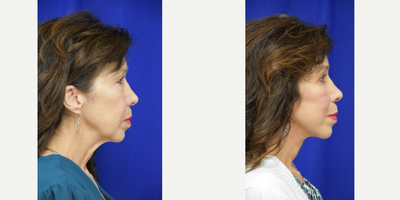 55-64 year old woman treated with Facelift, Neck Lift, Double Eyelid Surgery, Ptosis Surgery, Brow Lift - 3694 Treated with Facelift, Neck Lift, Double Eyelid Surgery, Ptosis Surgery, Brow Lift