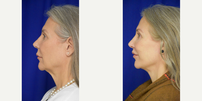 3112 55-64 year old woman treated with Lip Lift, Facelift, Brow Lift - 3112 55-64 year old woman treated with Lip Lift, Facelift, Brow Lift