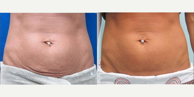 35-44 year old woman treated with Pelleve - Pellev is a non-ablative skin tightening system that uses radiowave technology to give patients a painless cosmetic treatment that feels like a warm massage