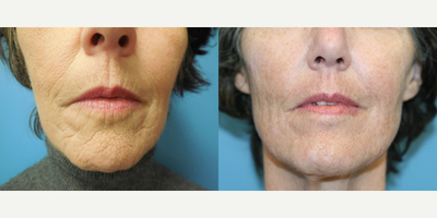 58 year old woman treated with Fractional Laser - This patient had a series of 3 Fractional perioral treaments to address wrinkles around her mouth and chin.