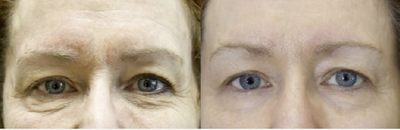 Woman treated with Exilis - Woman treated with Exilis