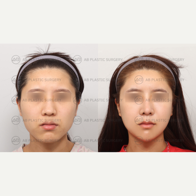 25-34 year old woman treated with Canthoplasty, Ptosis Surgery, Rhinoplasty - By: Dr. Ahn Seung Hyun, Dr. Bae In Ho, Dr. Kim Joo Yeon