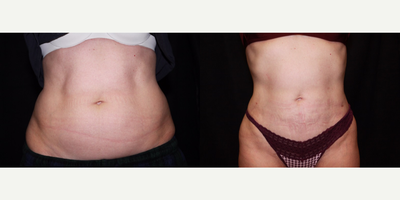 Laser Liposuction - Lower Abdomen, Flanks - Laser Liposuction - Lower Abdomen, Flanks
