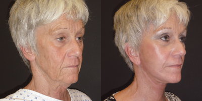55-64 year old woman treated with Quick Lift - 55-64 year old woman treated with Quick Lift
