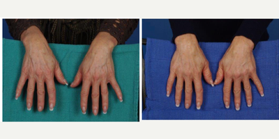 55-64 year old woman treated with Volbella - Filler to hands